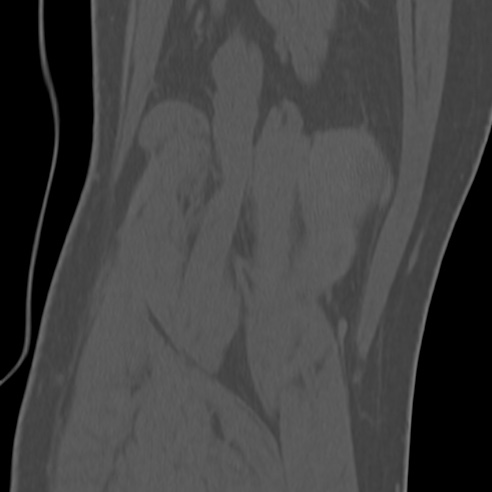 File:Anterior cruciate ligament avulsion fracture (Radiopaedia 58939-66194 Coronal bone window 30).jpg