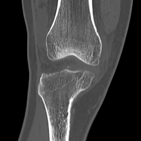 File:Anterior cruciate ligament avulsion fracture (Radiopaedia 58939-66194 Coronal bone window 6).jpg