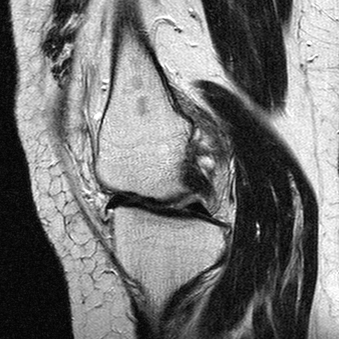 File:Anterior cruciate ligament mucoid degeneration (Radiopaedia 60853-68633 Sagittal T2 12).jpg