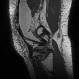 Anterior cruciate ligament rupture with Segond fracture (Radiopaedia 69043-78806 Sagittal PD 157).jpg
