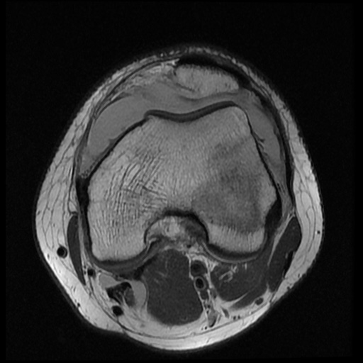 File:Anterior cruciate ligament tear (Radiopaedia 61500-69462 Axial PD 8).jpg