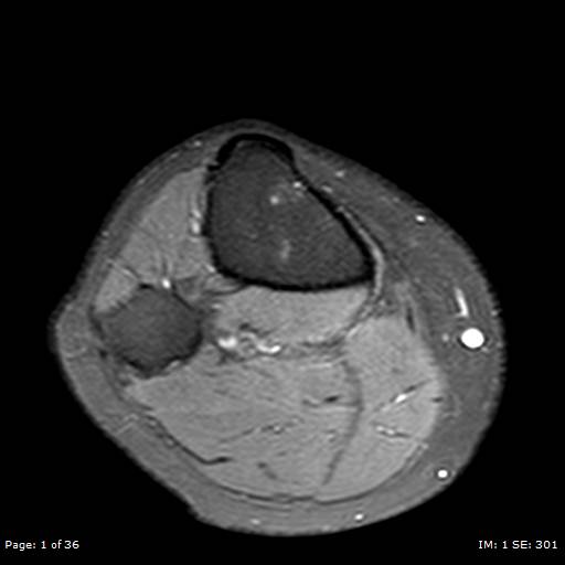 File:Anterior cruciate ligament tear (Radiopaedia 70783-80964 Axial PD fat sat 1).jpg