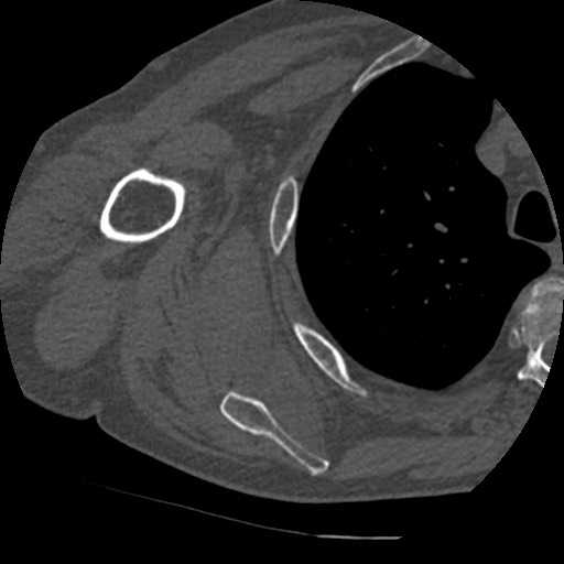 Anterior glenohumeral dislocation with Hill-Sachs lesion (Radiopaedia 62877-71249 Axial bone window 63).jpg