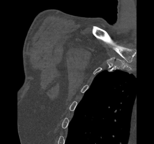 Anterior glenohumeral dislocation with Hill-Sachs lesion (Radiopaedia 62877-71249 Coronal bone window 3).jpg