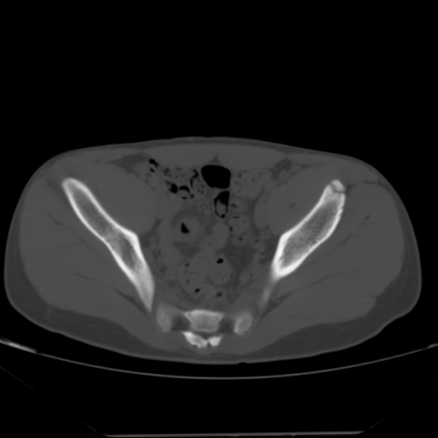 Anterior inferior iliac spine avulsion fracture (Radiopaedia 49469-54627 Axial bone window 24).jpg