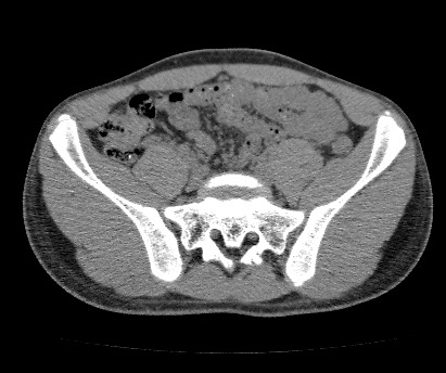 Anterior inferior iliac spine avulsion fracture (Radiopaedia 81312-94999 Axial non-contrast 26).jpg