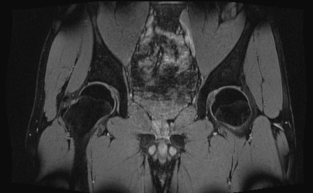 Anterior inferior iliac spine avulsion fracture (Radiopaedia 81312-95000 G 45).jpg
