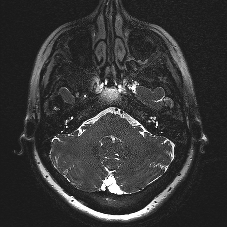 Anterior temporal encephalocele (Radiopaedia 82624-96808 Axial T2 high res 5).jpg