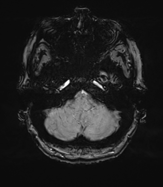 Anterior temporal pole cysts (Radiopaedia 46629-51102 Axial SWI 17).png