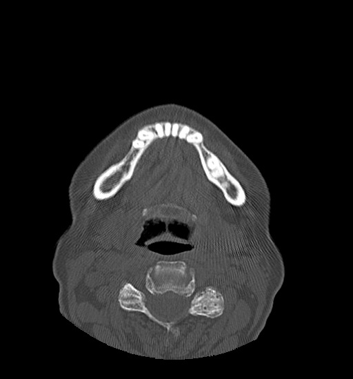 Anterior temporomandibular joint dislocation (Radiopaedia 59430-66784 Axial non-contrast 50).jpg