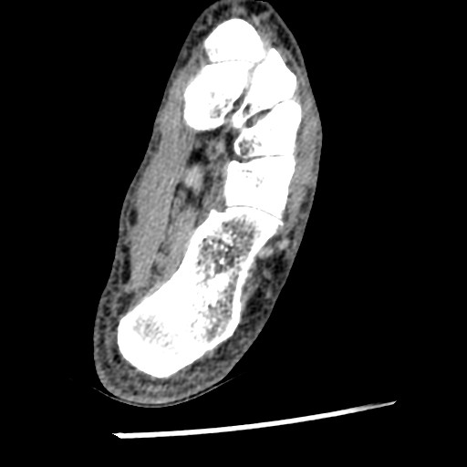 File:Anterior tibial artery false aneurysm (Radiopaedia 88984-105809 A 197).jpg