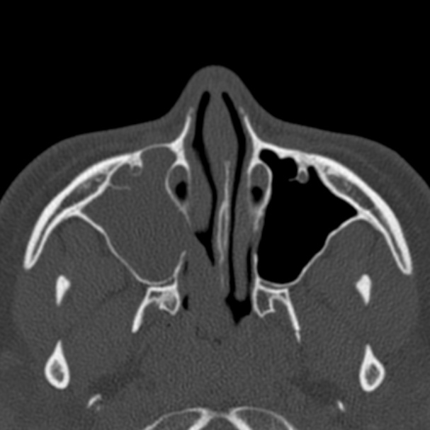 Antrochoanal polyp (Radiopaedia 33984-35202 Axial bone window 27).jpg