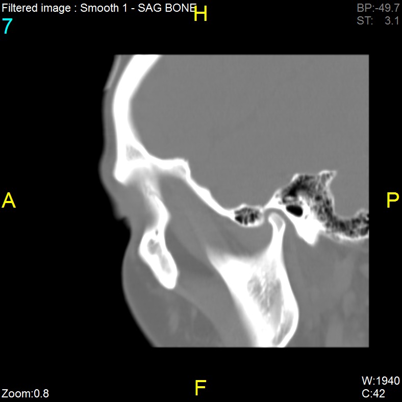 Antrochoanal polyp (Radiopaedia 65101-74094 Sagittal bone window 7).jpg