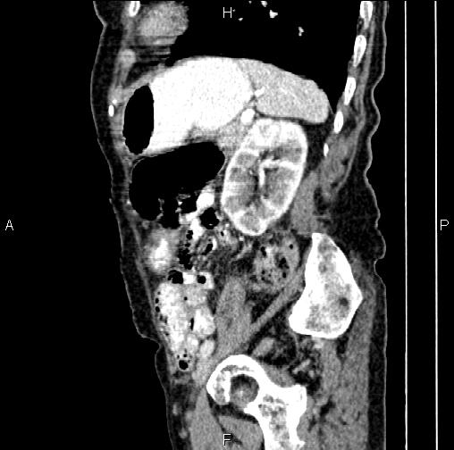File:Aortic aneurysm and Lemmel syndrome (Radiopaedia 86499-102554 D 66).jpg
