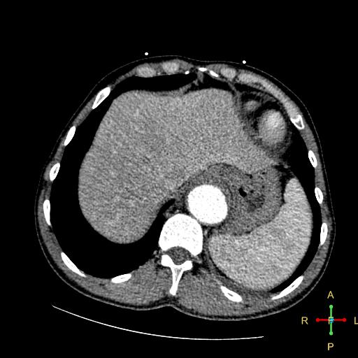 File:Aortic aneurysm and penetrating ulcer (Radiopaedia 23590-23704 A 27).jpg