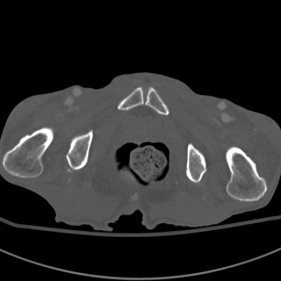 Aortic aneurysm with spinal destruction (Radiopaedia 42301-45410 Axial bone window 117).jpg