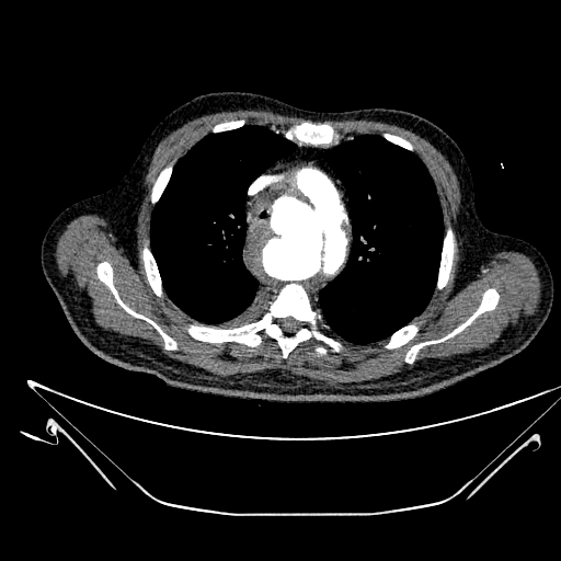 Aortic arch aneurysm (Radiopaedia 84109-99365 B 207).jpg
