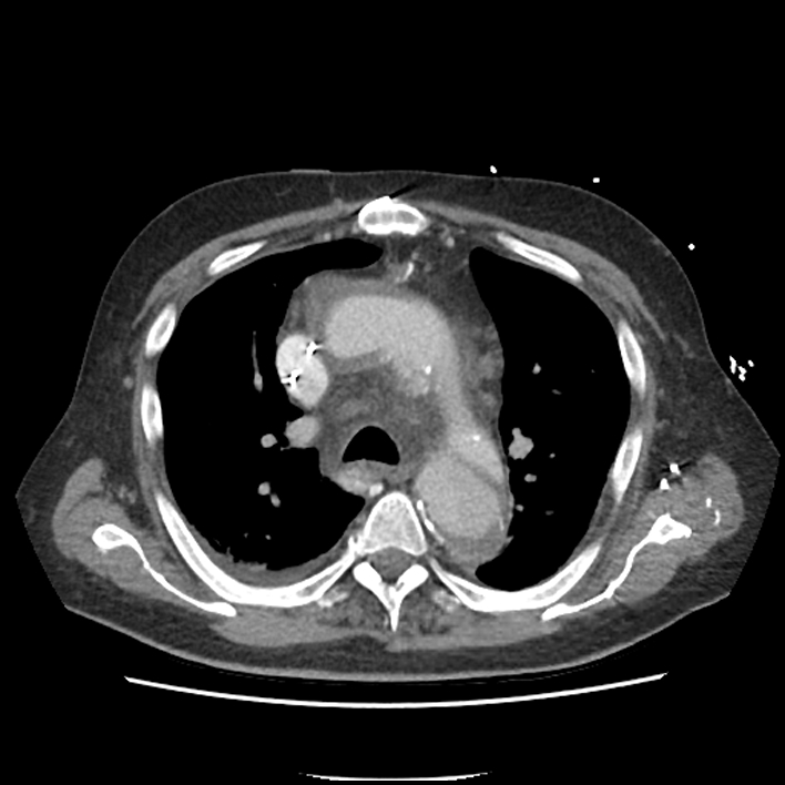 Aortic arch graft infection (FDG PET-CT) (Radiopaedia 71975-82437 A 19).jpg