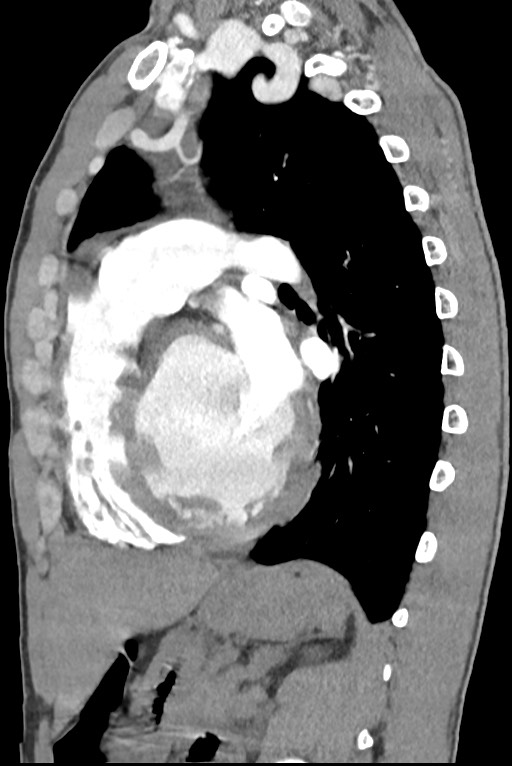 Aortic coarctation with aneurysm (Radiopaedia 74818-85828 B 101).jpg
