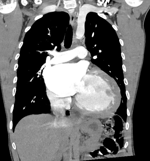 Aortic coarctation with aneurysm (Radiopaedia 74818-85828 C 58).jpg