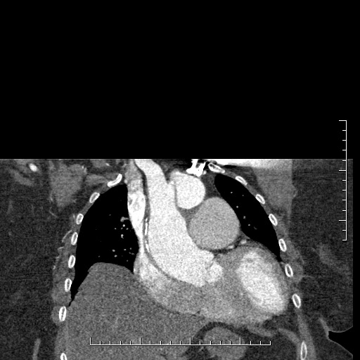 Aortic dissection- Stanford A (Radiopaedia 35729-37268 E 46).jpg