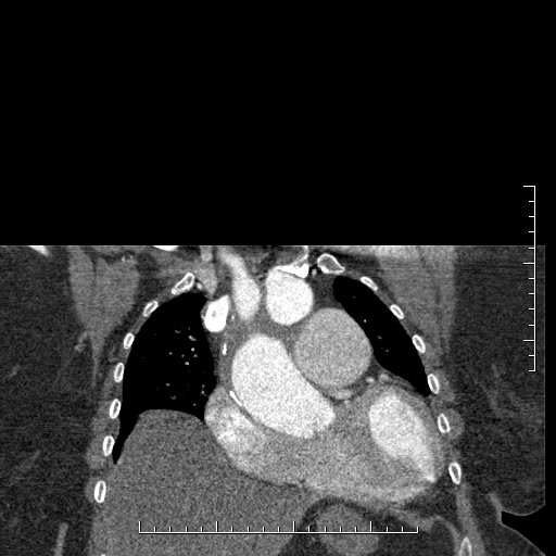 Aortic dissection- Stanford A (Radiopaedia 35729-37268 E 49).jpg