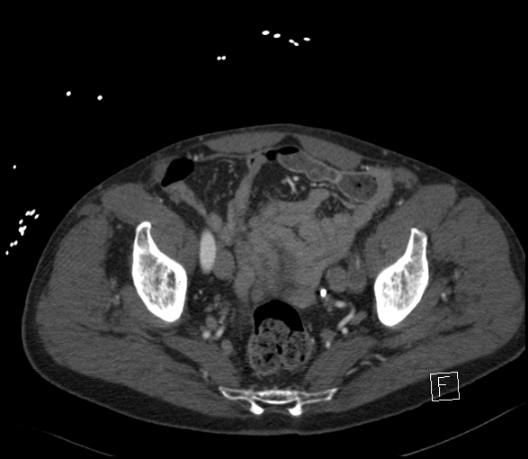 Aortic dissection (CTPA) (Radiopaedia 75506-86750 E 130).jpg