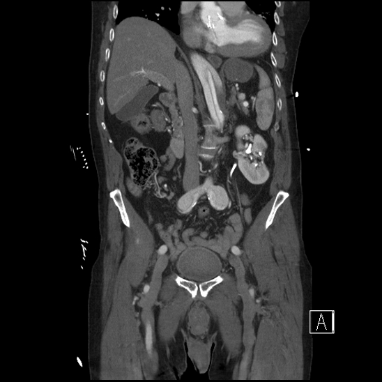 File:Aortic dissection (CTPA) (Radiopaedia 75506-86750 F 31).jpg