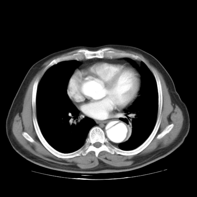 Aortic dissection (Radiopaedia 44411-48061 C 15).jpg