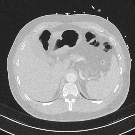 File:Aortic dissection (Radiopaedia 50763-56234 Axial lung window 61).png