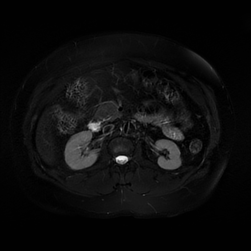 File:Aortic dissection (Radiopaedia 57969-64956 Axial T2 fat sat 32).jpg
