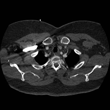 File:Aortic dissection (Radiopaedia 57969-64959 A 46).jpg