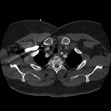 Aortic dissection (Radiopaedia 57969-64959 A 48).jpg