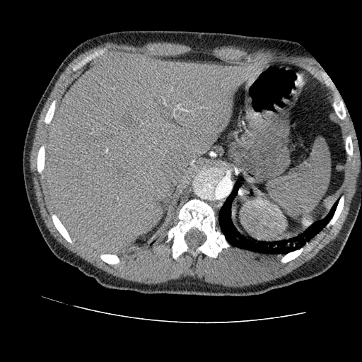 File:Aortic dissection - Stanford A -DeBakey I (Radiopaedia 28339-28587 B 103).jpg