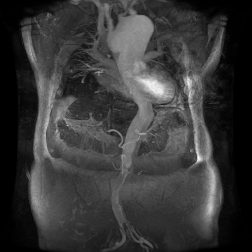 Aortic dissection - Stanford A - DeBakey I (Radiopaedia 23469-23551 D 1).jpg