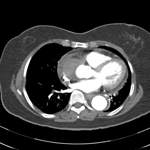 File:Aortic dissection - Stanford type A (Radiopaedia 39073-41259 A 47).png
