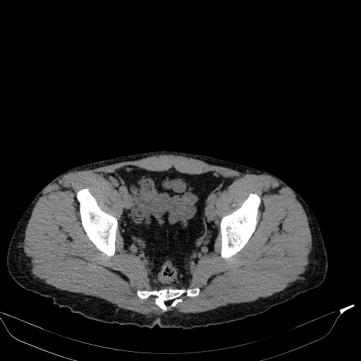 Aortic dissection - Stanford type A (Radiopaedia 83418-98500 Axial non-contrast 84).jpg