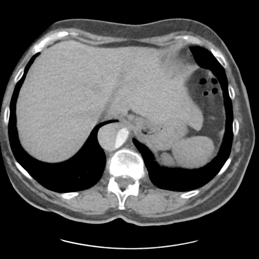File:Aortic dissection - Stanford type B (Radiopaedia 50171-55512 A 43).png