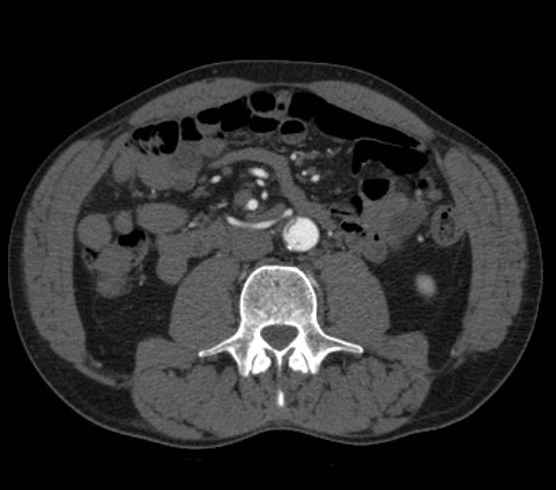 Aortic dissection - Stanford type B (Radiopaedia 73648-84437 A 170).jpg
