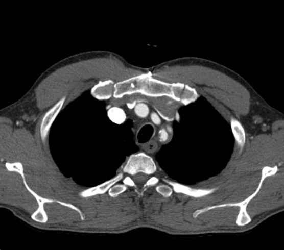 File:Aortic dissection - Stanford type B (Radiopaedia 73648-84437 A 6).jpg
