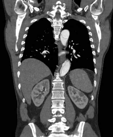 File:Aortic dissection - Stanford type B (Radiopaedia 73648-84437 B 81).jpg