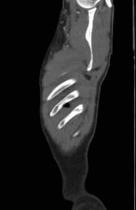 File:Aortic dissection - Stanford type B (Radiopaedia 73648-84437 C 2).jpg