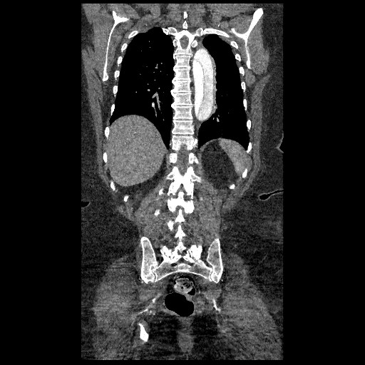 File:Aortic dissection - Stanford type B (Radiopaedia 88281-104910 B 68).jpg