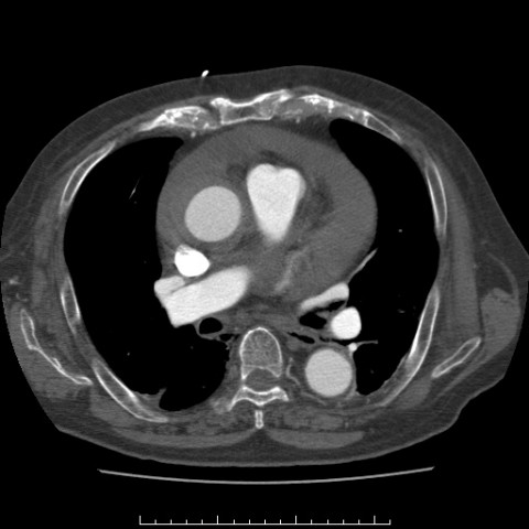 File:Aortic dissection with rupture into the pericardial sac (Radiopaedia 23726-23879 C+ arterial phase 4).jpg