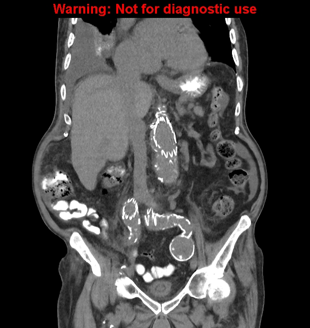 Aortic graft infection (Radiopaedia 44979-48907 non-contrast 25).jpg