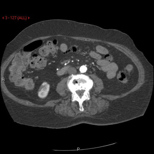 Aortic intramural hematoma (Radiopaedia 27746-28001 A 127).jpg