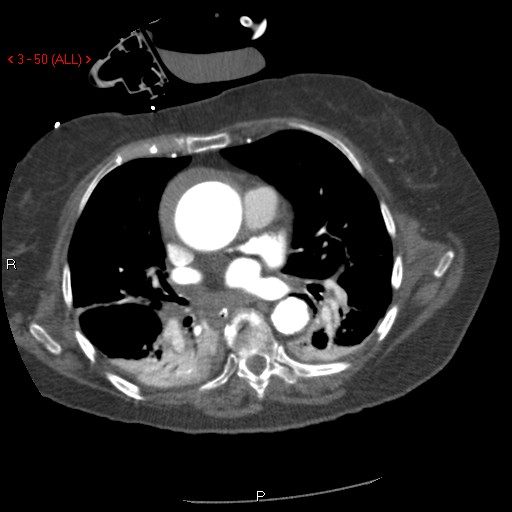 File:Aortic intramural hematoma (Radiopaedia 27746-28001 A 50).jpg