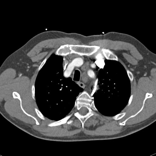 Aortic intramural hematoma (Radiopaedia 31139-31838 B 20).jpg
