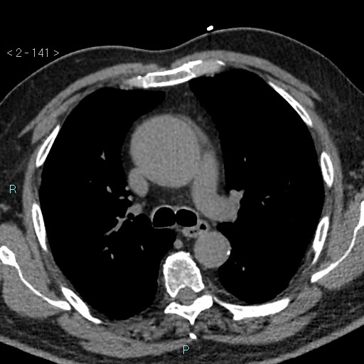 Aortic intramural hematoma (Radiopaedia 48463-53380 Axial non-contrast 63).jpg