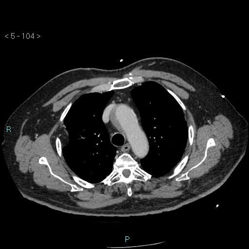 Aortic intramural hematoma (Radiopaedia 48463-53380 C 48).jpg